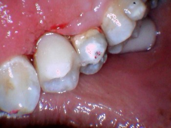 after photo of the tooth completely rebuilt using white filling material