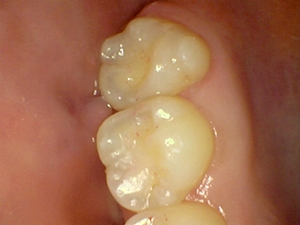 an after photo of new white fillings that blend in with the tooth much better