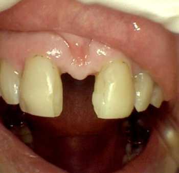 before photo of a large space between the two front teeth