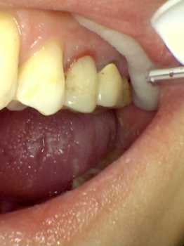 after photo of the dark tooth root now covered with a white filling
