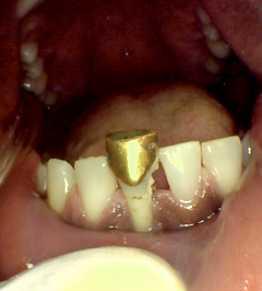 Before photo of a front tooth with a gold crown that needed to be removed